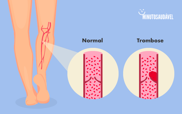 Chás e Fitoterápicos: Quais Evitar e Quais Podem Ajudar na Circulação? - inspiração 3