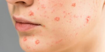 Cuidado com o Glúten: A Sensibilidade Que Pode Agredir Sua Pele - inspiração 3