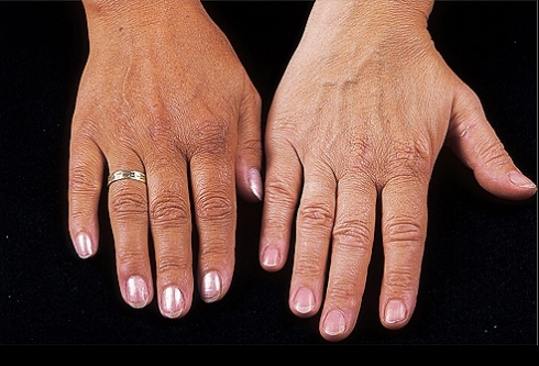 Guia Completo de Suplementação para Addison