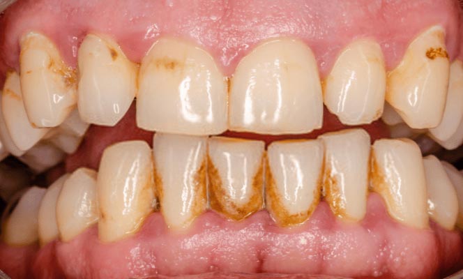 O Papel da Hidratação na Saúde Bucal