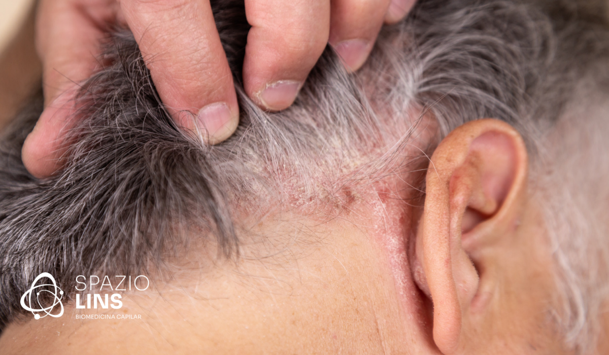 Receitas saudáveis para controlar a oleosidade da pele