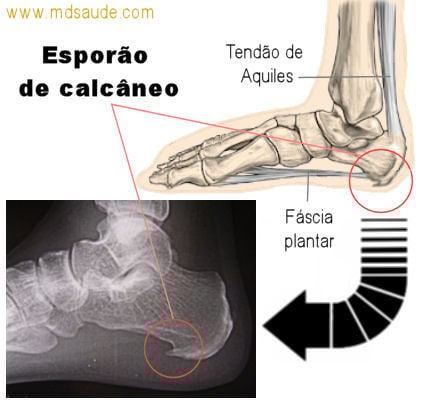 5 Exercícios de Alongamento Essenciais para Aliviar o Esporão de Calcâneo