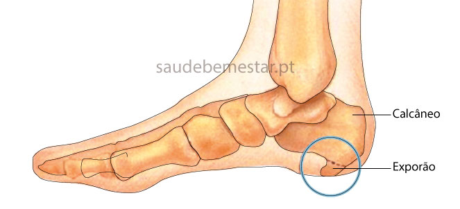 Como o Controle de Peso Impacta a Dor do Esporão de Calcâneo