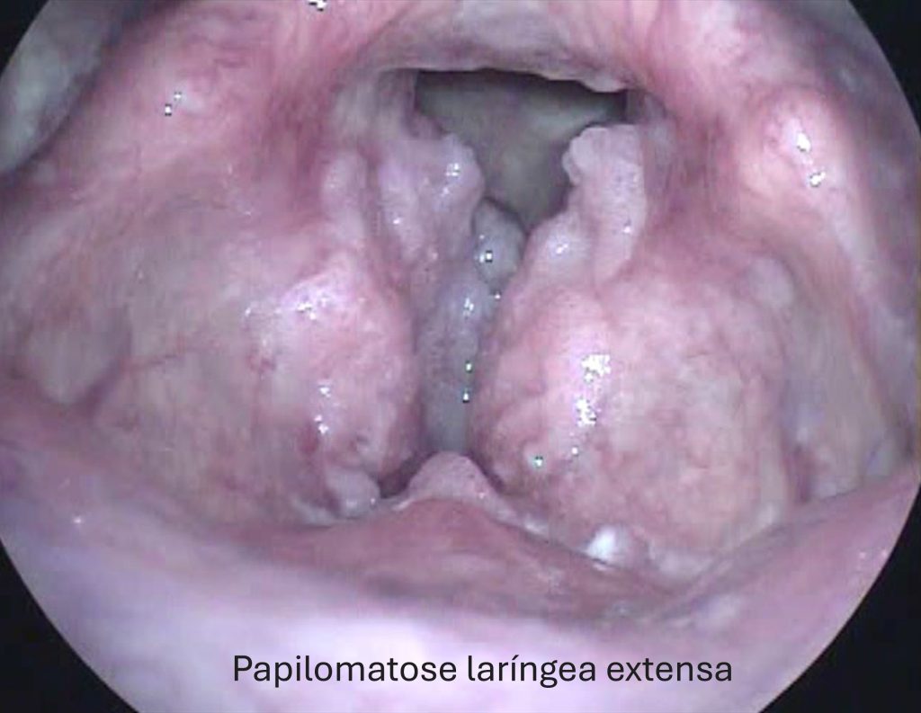 5 Alimentos que Combatem o HPV Naturalmente