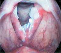 Receitas Saudáveis para Laringe Irritada