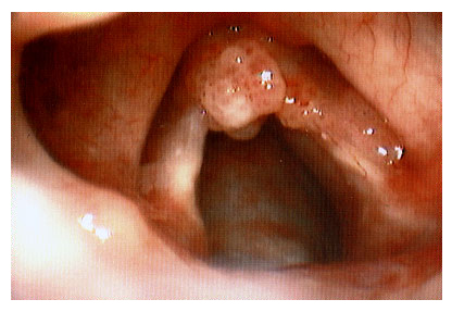 Como o Refluxo Afeta a Voz: Entenda a Conexão