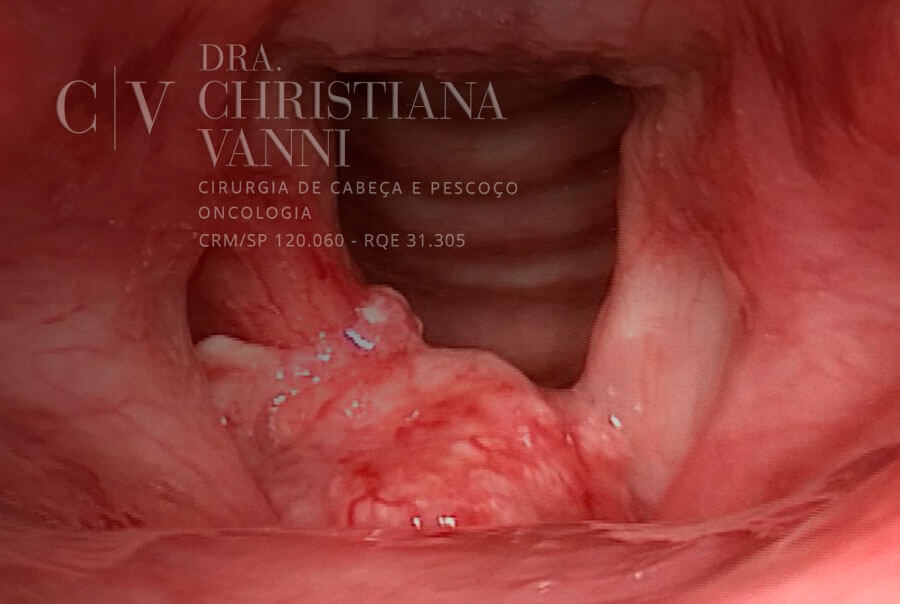 Receitas Saudáveis para Laringe Irritada