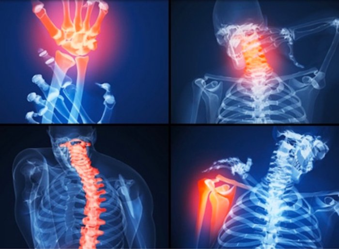Guia Completo de Suplementos para Artrite