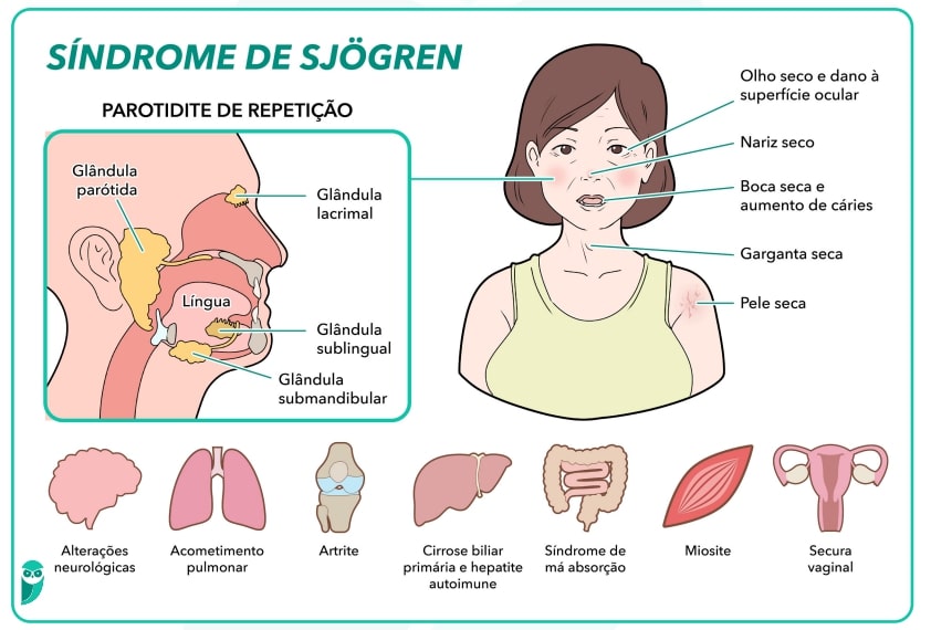 Receitas de Smoothies para Aliviar a Boca Seca com Sjögren