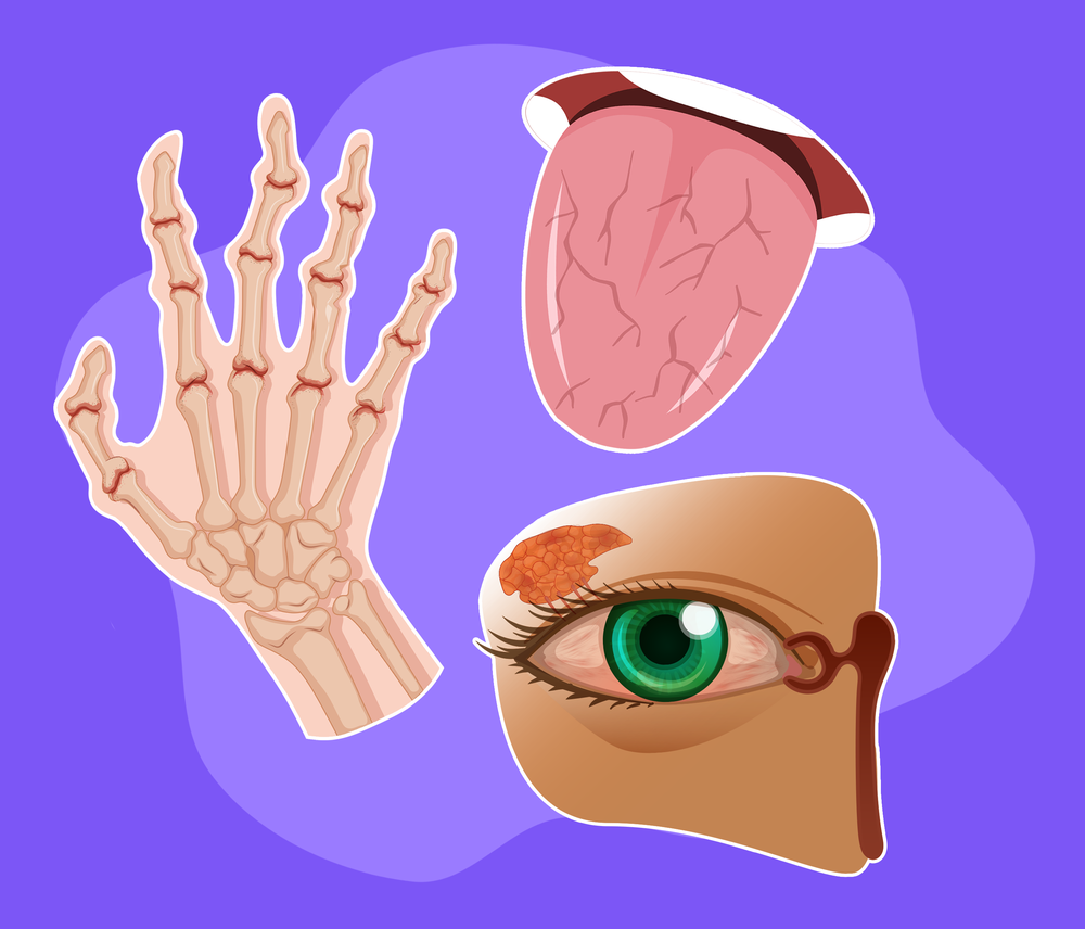 Guia Completo de Hidratação para Pacientes com Sjögren