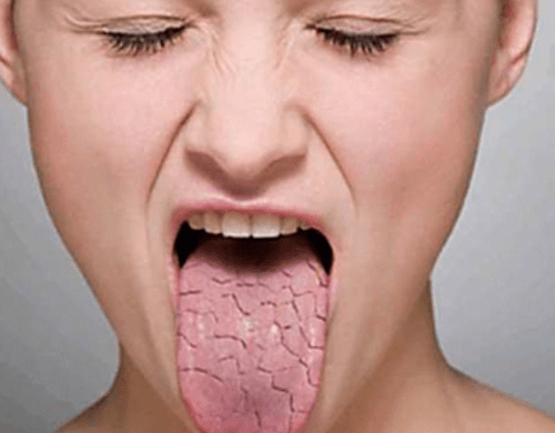 Como a Vitamina A Protege os Olhos na Síndrome de Sjögren