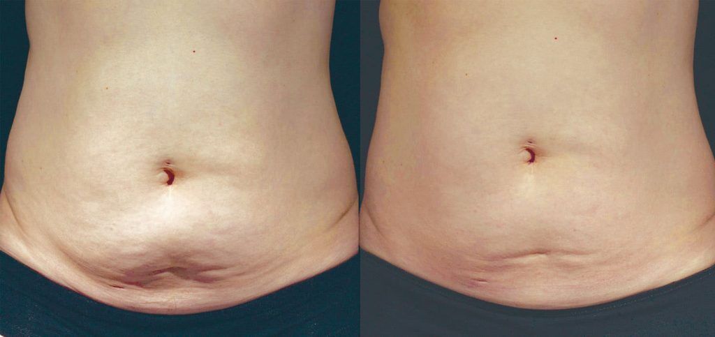 colágeno para flacidez funciona