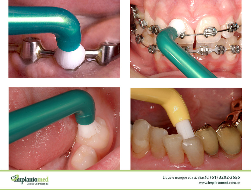 A Importância da Escova Interdental na Higiene com Aparelho