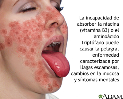 deficiência de vitamina b3 niacina sintomas