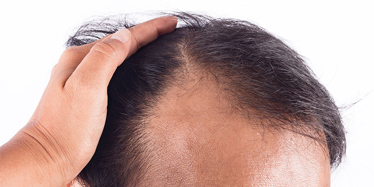 dieta para quem tem calvície androgenética