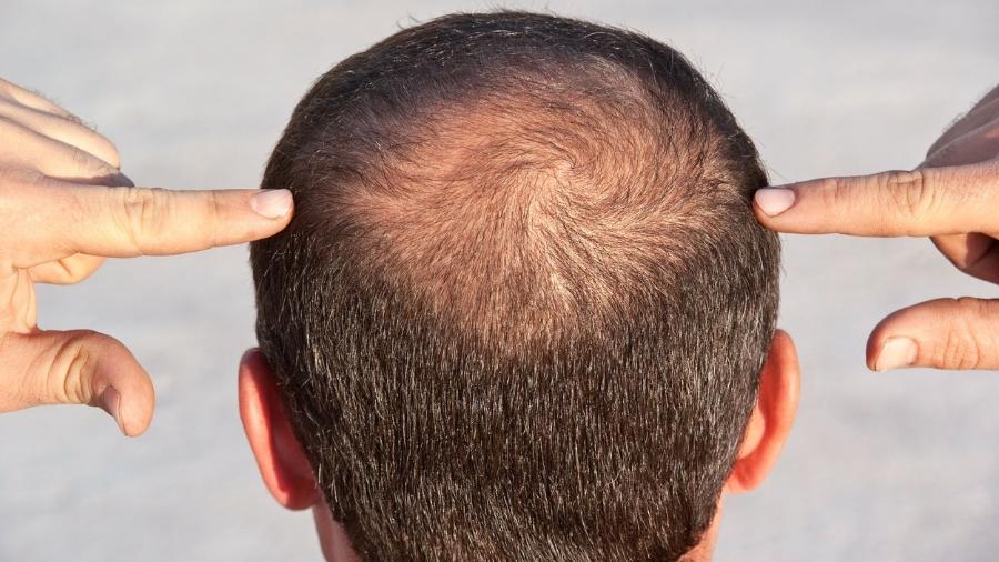 dieta para quem tem calvície androgenética