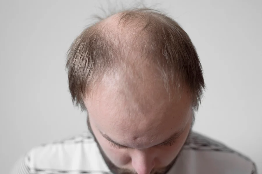 dieta para quem tem calvície androgenética