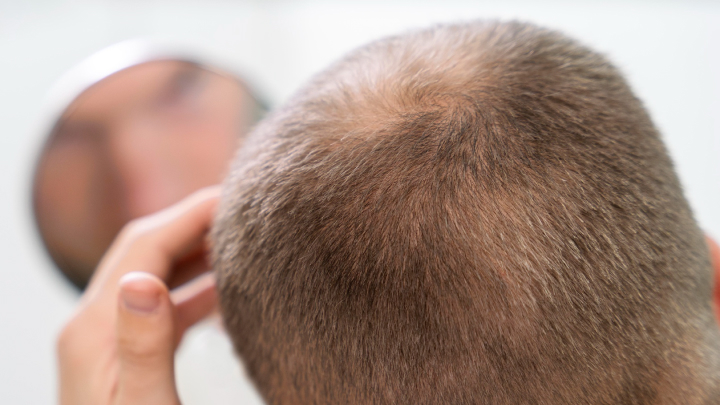 dieta para quem tem calvície androgenética