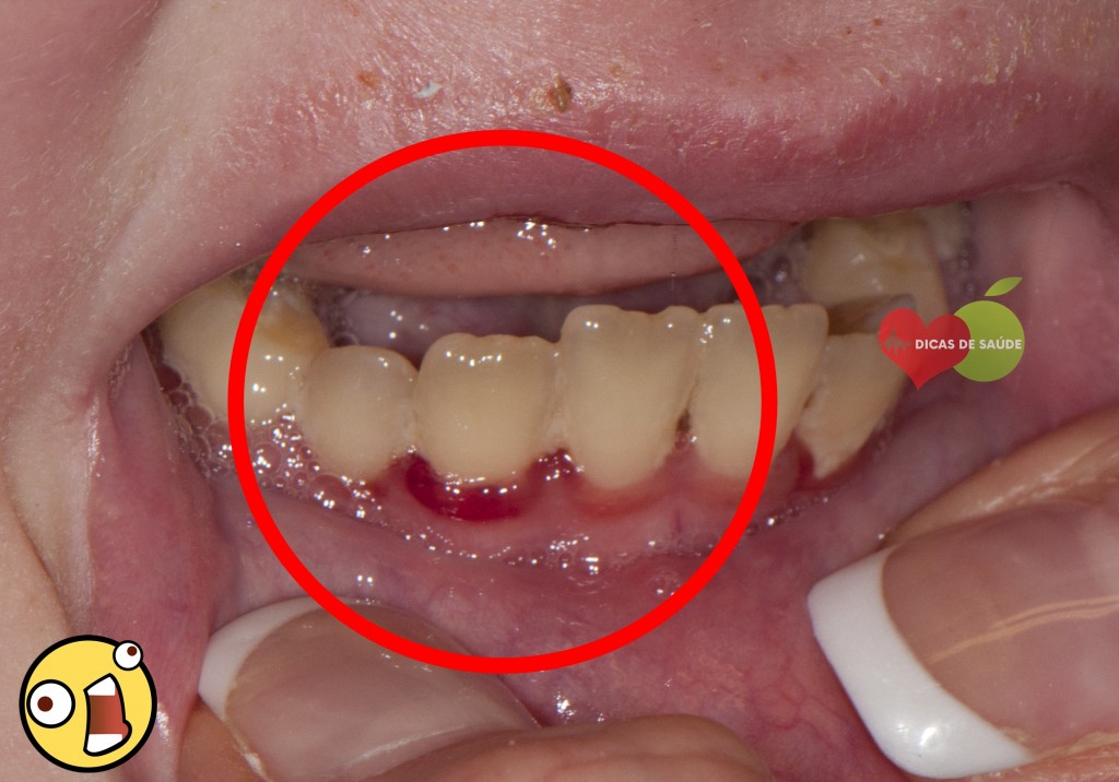 excesso de vitamina c sintomas