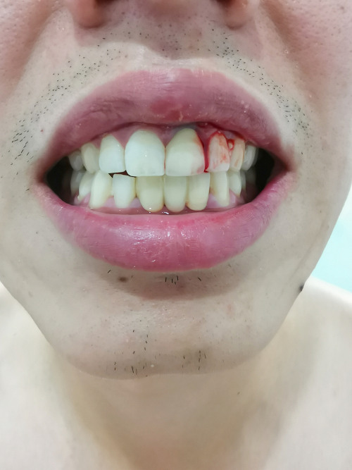 excesso de vitamina c sintomas