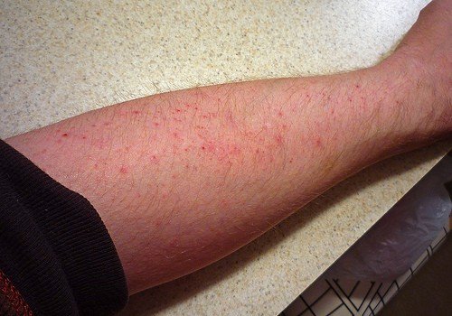 erros comuns ao tomar vitamina d e problemas de pele