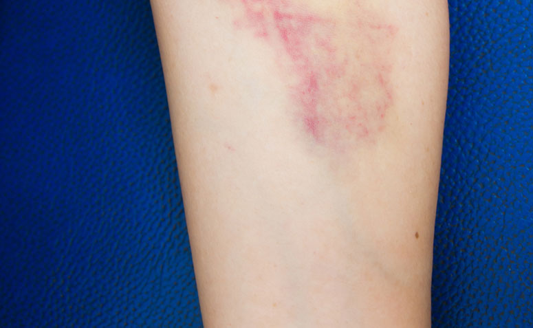 excesso de vitamina k sintomas