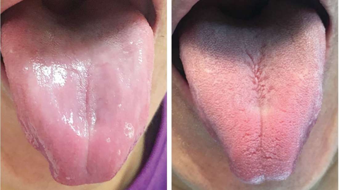 sintomas falta vitamina b12 língua