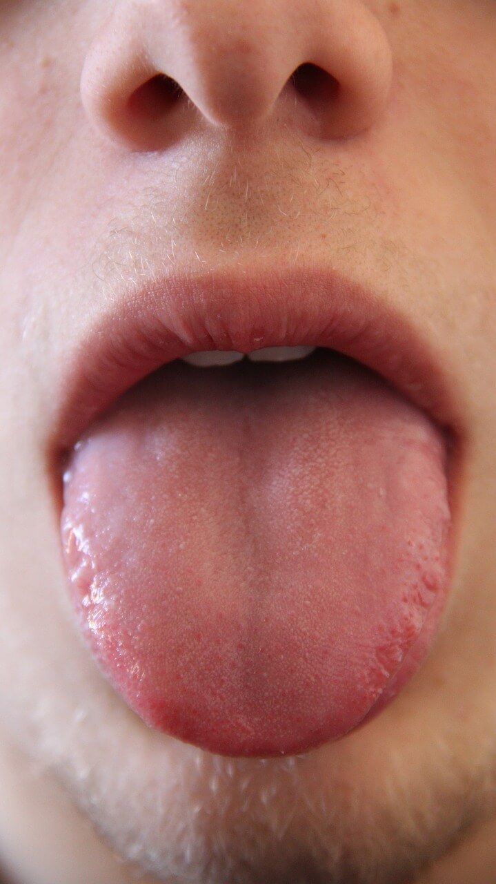 glossite atrófica vitamina b12