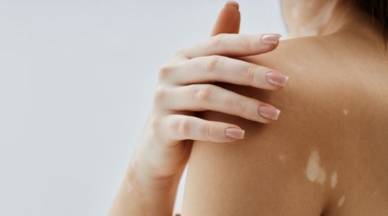 Vitiligo e Vitamina B12: Existe uma Conexão?