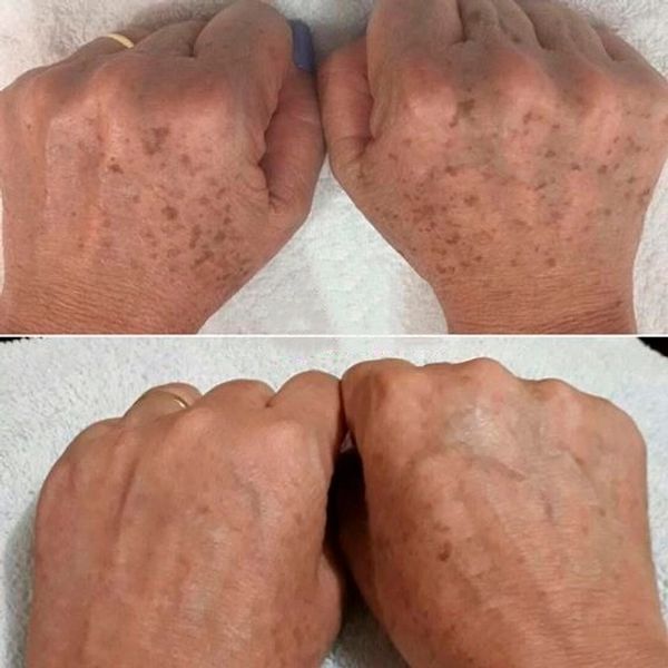 Palidez e Pele Amarelada: Indicativos de Baixos Níveis de B12?