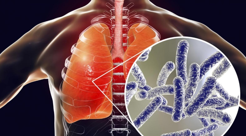 o que é a doença do legionário e jardinagem