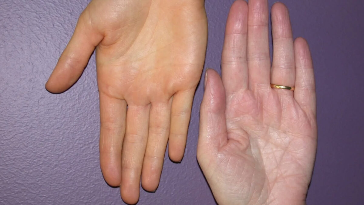 pele amarelada falta de vitamina