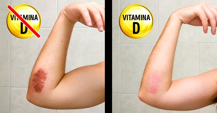 quais os sintomas da falta de vitamina d