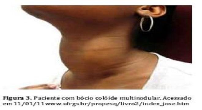 Como o Iodo Afeta o Desenvolvimento Cerebral do Bebê