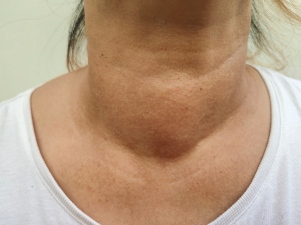 Alimentos Ricos em Iodo para Prevenir a Deficiência