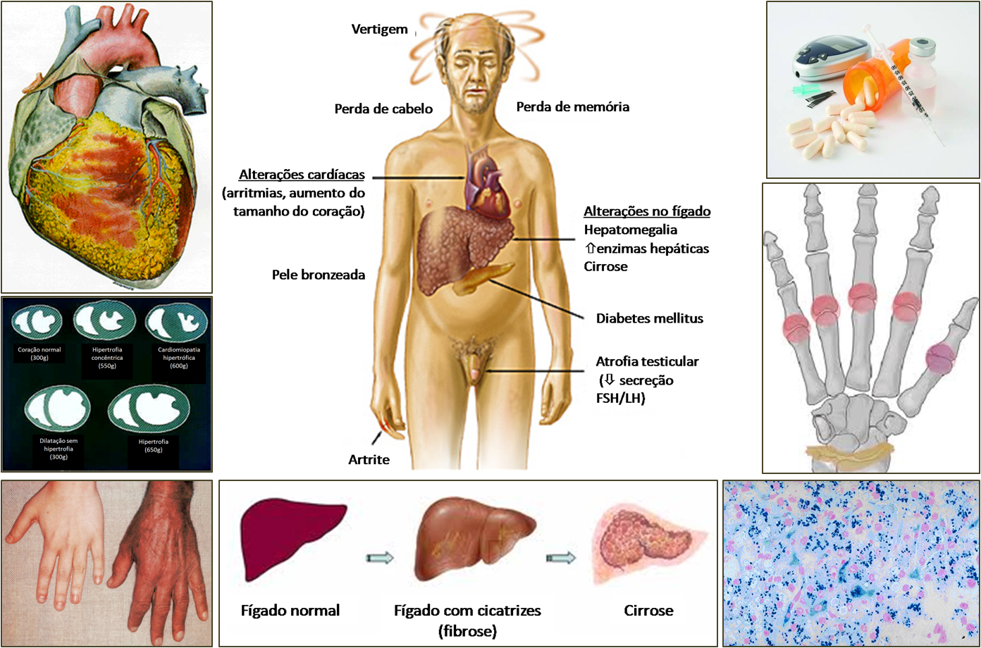 sintomas de excesso de ferro no organismo