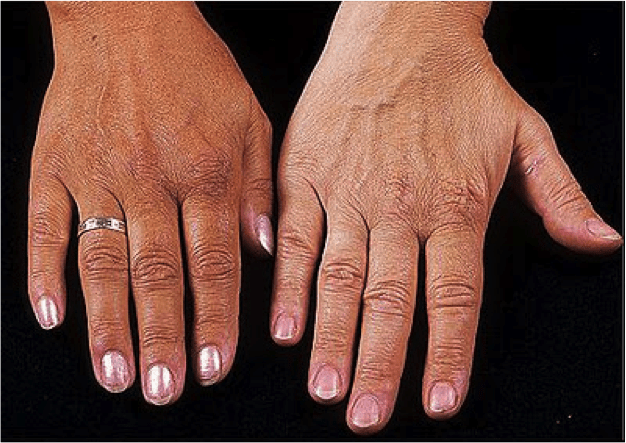 Sintomas e Diagnóstico