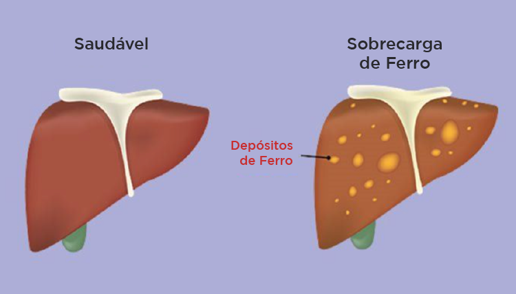 sintomas de excesso de ferro no organismo
