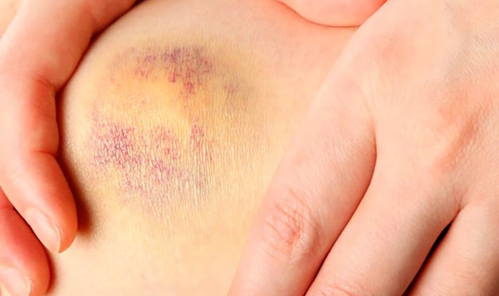 sintomas de falta de vitamina k