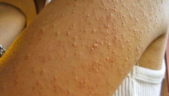 Como Lidar com a Sensibilidade ao Glúten no Dia a Dia