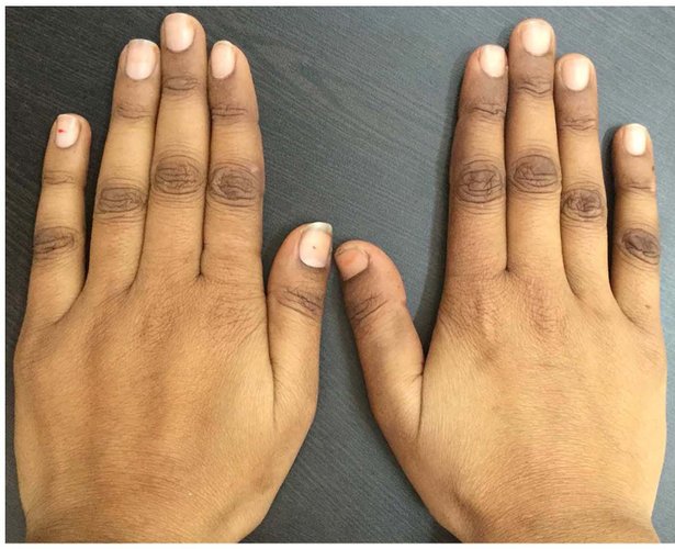 Desvendando os Sintomas de Hipervitaminose B12 na Pele e Digestão