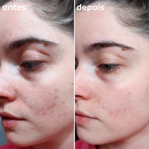 vitamina c clareia melasma