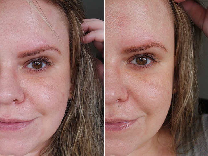 melano cc causa espinhas