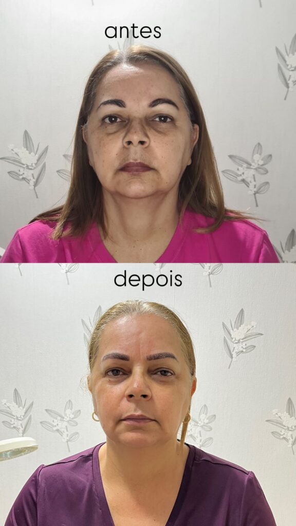 5 ideias de títulos:
1. Vitamina C: O Segredo para uma Pele Livre de Manchas
2. Como a Vitamina C Combate Manchas e Melasma: Guia Completo
3. Os Melhores Produtos com Vitamina C para Clarear sua Pele
4. Vitamina C no Skincare: Benefícios